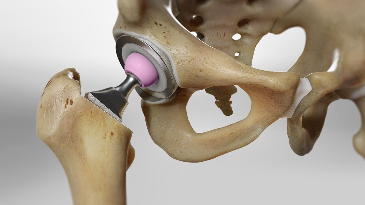 Knee Arthroplasty