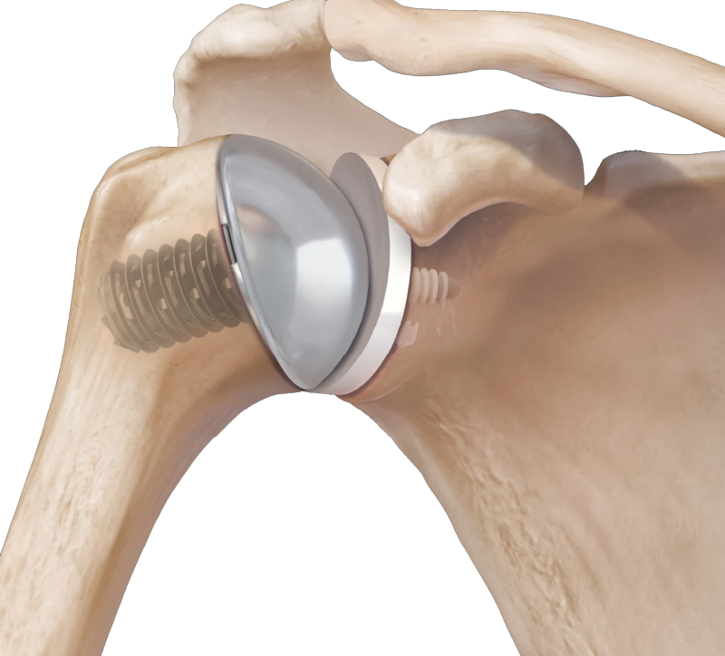 Resurfacing Shoulder Arthroplasty in Delhi