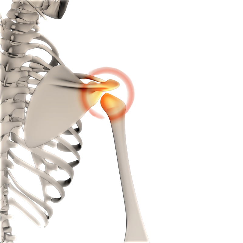 Reverse Shoulder Arthroplasty in Delhi