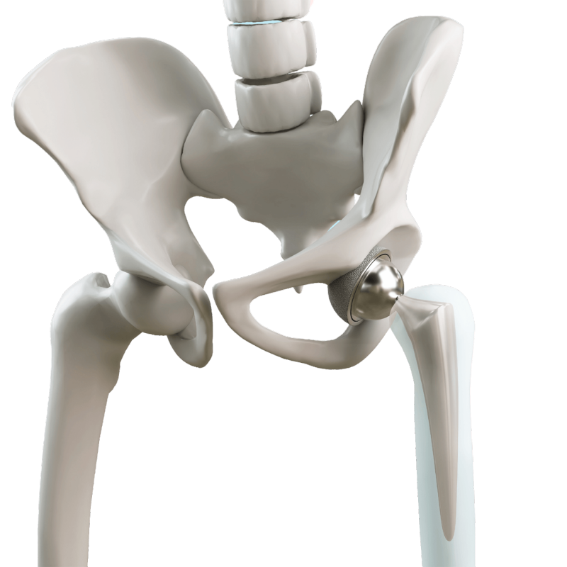 total hip replacement